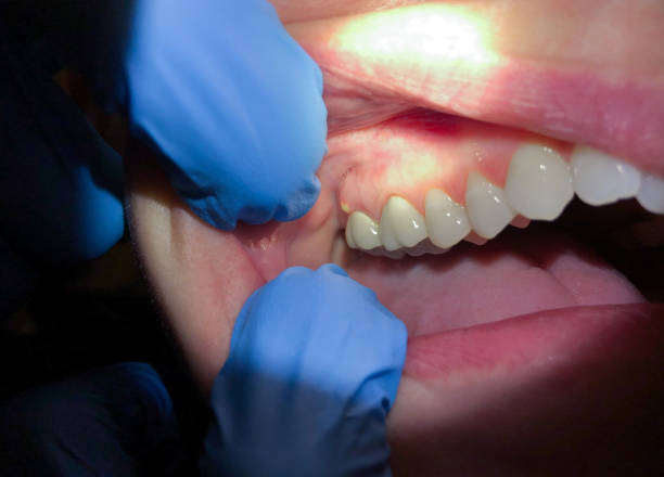 Best Broken or Cracked Tooth Emergency Dentist in Northern Cambria, PA